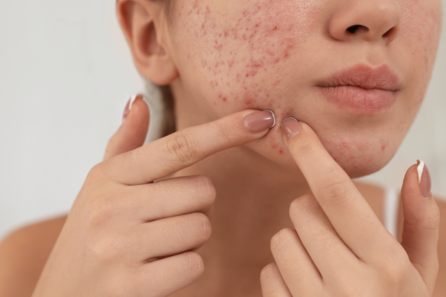 femme en train d essayer de percer un bouton sur son visage