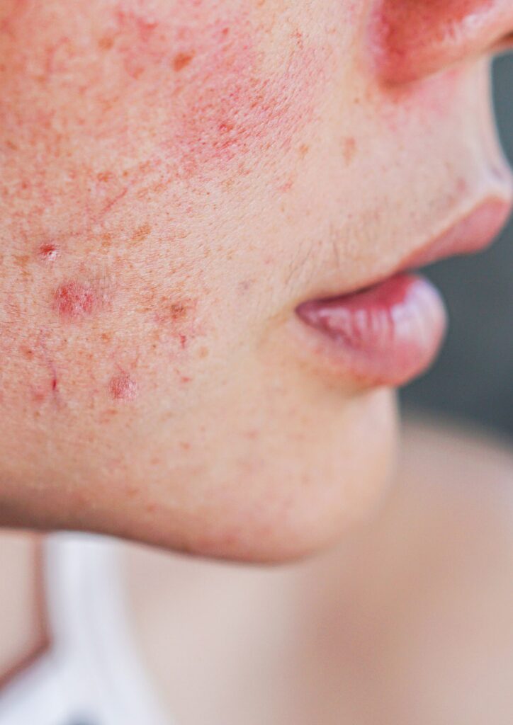 Microbiote & acné comment un intestin équilibré peut limiter les bactéries responsables des imperfections
